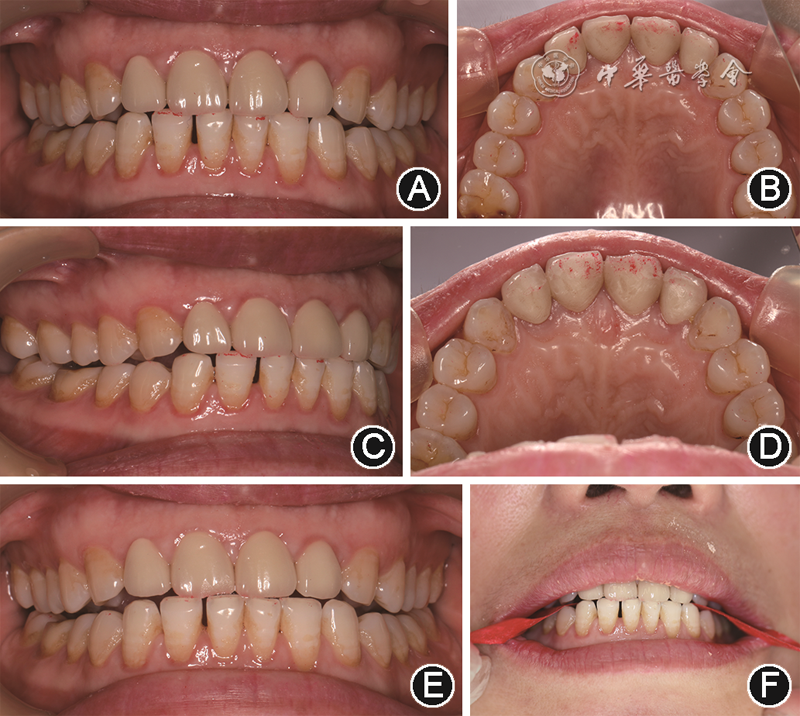 mmd在医学上什么意思【专家笔谈】咀嚼肌功能紊乱和修复专科处理_https://www.jmylbn.com_新闻资讯_第4张