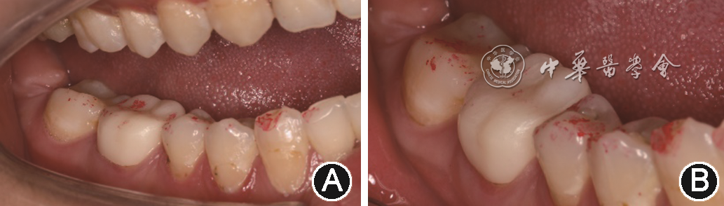 mmd在医学上什么意思【专家笔谈】咀嚼肌功能紊乱和修复专科处理_https://www.jmylbn.com_新闻资讯_第3张