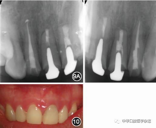 【临床典型病例分析】根管治疗失败患牙再治疗一例