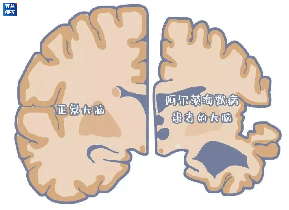怎么看护瘫痪老人阿尔兹海默病（老年痴呆）有哪些表现？如何看护患者？_https://www.jmylbn.com_新闻资讯_第2张