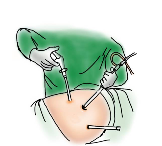 什么是软式内镜镜急诊科普 ｜微创手术—什么是腔镜手术？_https://www.jmylbn.com_新闻资讯_第6张