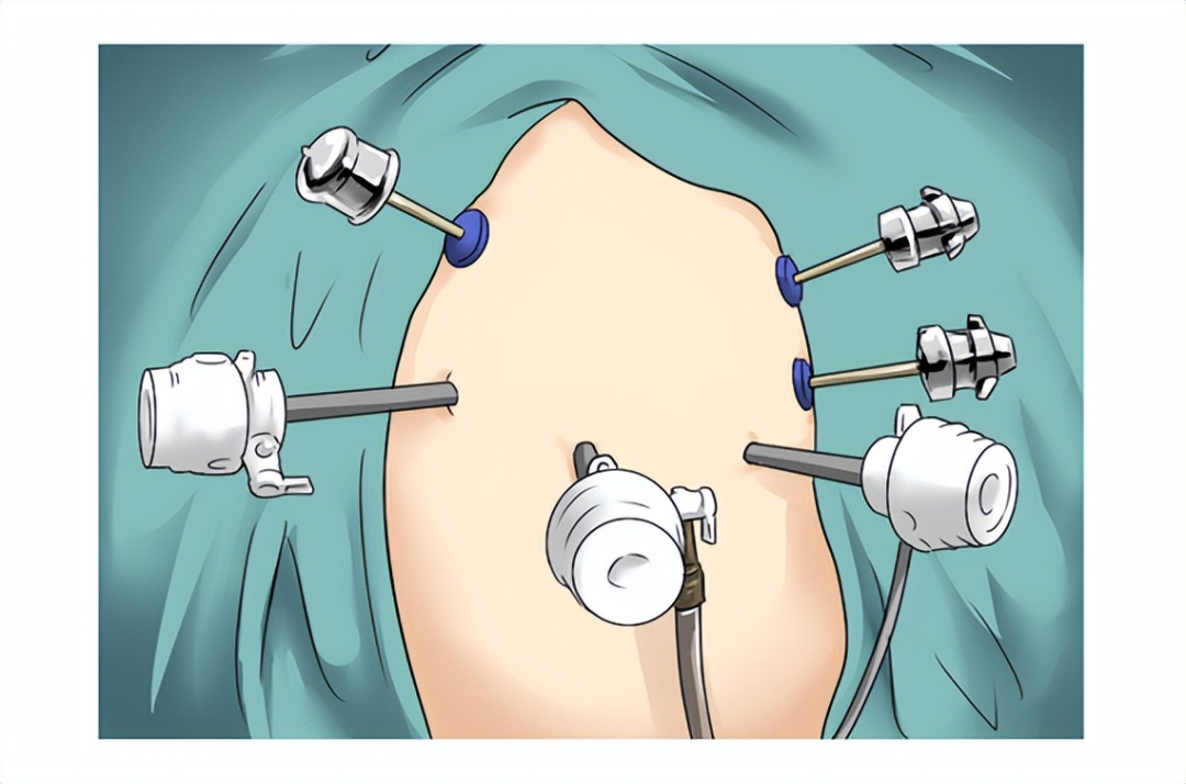 什么是软式内镜镜急诊科普 ｜微创手术—什么是腔镜手术？_https://www.jmylbn.com_新闻资讯_第8张