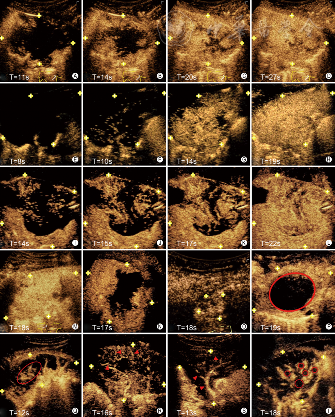同轴定位针怎么使用专家共识丨超声引导经皮肺穿刺活检中国专家共识（2025版）_https://www.jmylbn.com_新闻资讯_第9张