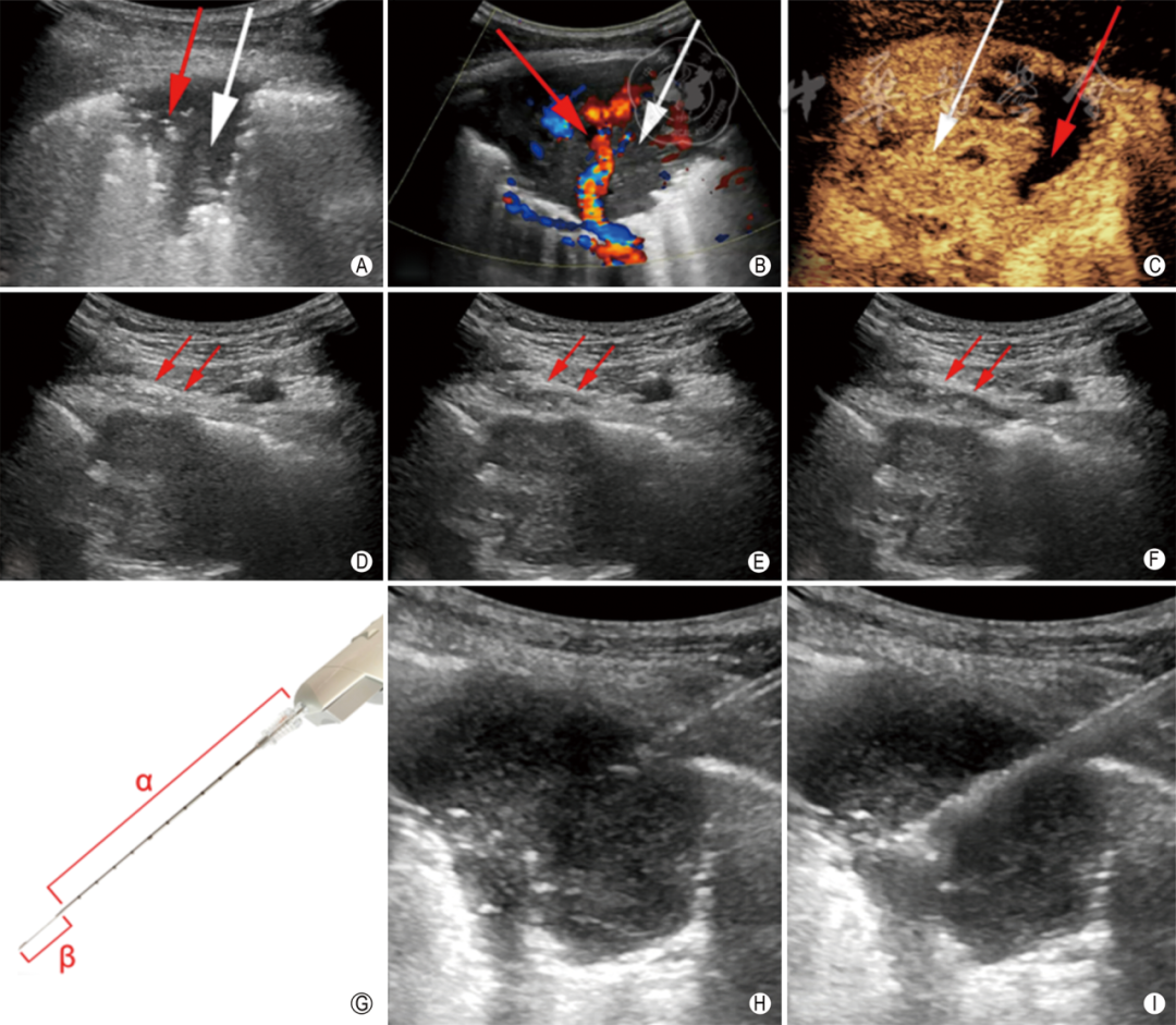 同轴定位针怎么使用专家共识丨超声引导经皮肺穿刺活检中国专家共识（2025版）_https://www.jmylbn.com_新闻资讯_第11张