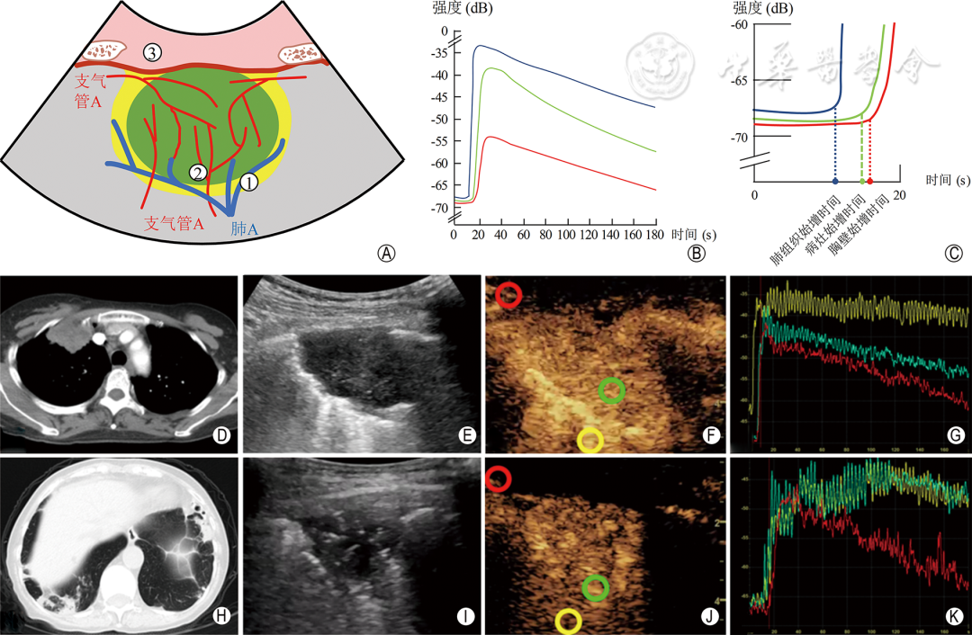 同轴定位针怎么使用专家共识丨超声引导经皮肺穿刺活检中国专家共识（2025版）_https://www.jmylbn.com_新闻资讯_第10张