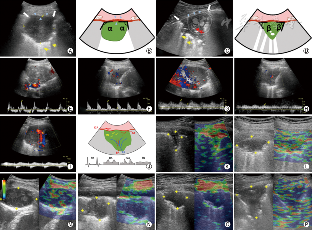 同轴定位针怎么使用专家共识丨超声引导经皮肺穿刺活检中国专家共识（2025版）_https://www.jmylbn.com_新闻资讯_第8张