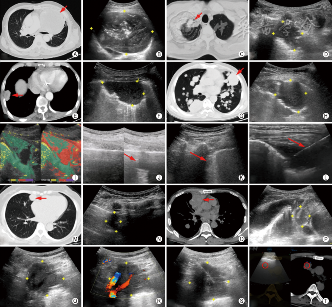 同轴定位针怎么使用专家共识丨超声引导经皮肺穿刺活检中国专家共识（2025版）_https://www.jmylbn.com_新闻资讯_第7张