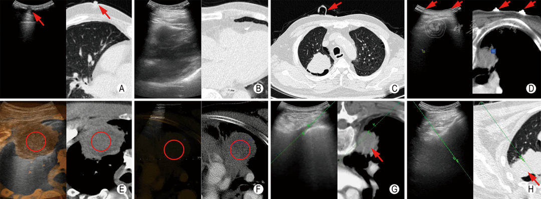 同轴定位针怎么使用专家共识丨超声引导经皮肺穿刺活检中国专家共识（2025版）_https://www.jmylbn.com_新闻资讯_第12张