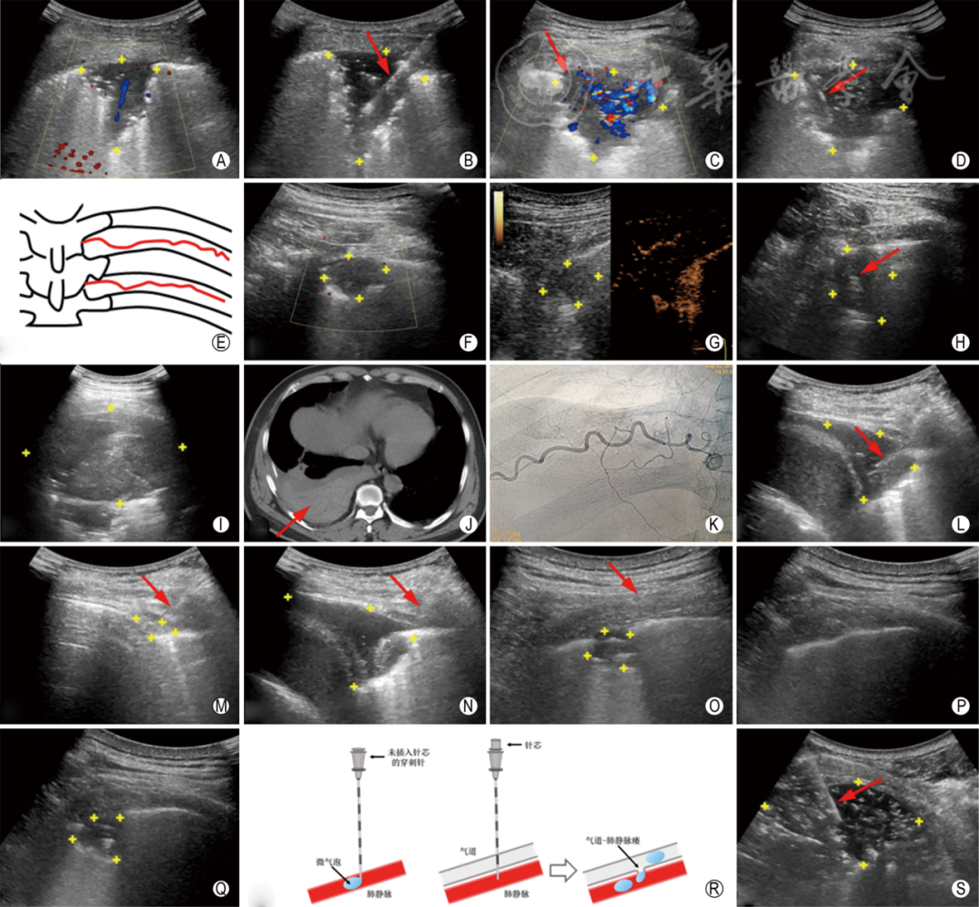 同轴定位针怎么使用专家共识丨超声引导经皮肺穿刺活检中国专家共识（2025版）_https://www.jmylbn.com_新闻资讯_第13张