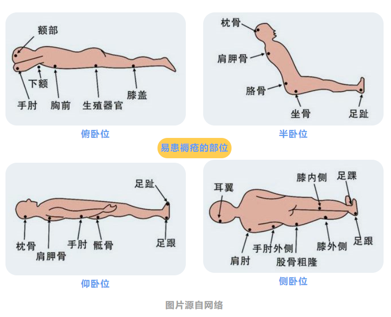 防压疮垫叫什么【护理】家有卧床老人，如何预防压疮？_https://www.jmylbn.com_新闻资讯_第6张