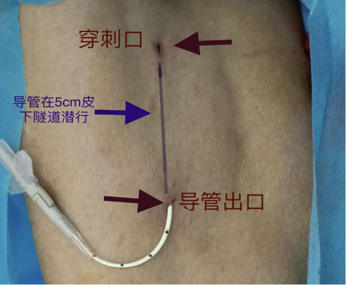 心电图怎么6道护理 ｜ 我院成功开展粤东首例腔内心电图定位下隧道式PICC置管术，化疗患者“生命绿色通道”更耐用_https://www.jmylbn.com_新闻资讯_第7张