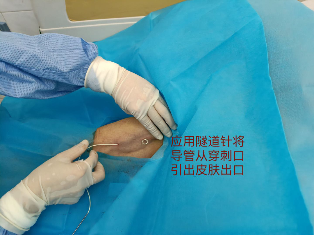 心电图怎么6道护理 ｜ 我院成功开展粤东首例腔内心电图定位下隧道式PICC置管术，化疗患者“生命绿色通道”更耐用_https://www.jmylbn.com_新闻资讯_第6张