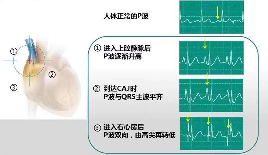 心电图怎么6道护理 ｜ 我院成功开展粤东首例腔内心电图定位下隧道式PICC置管术，化疗患者“生命绿色通道”更耐用_https://www.jmylbn.com_新闻资讯_第11张