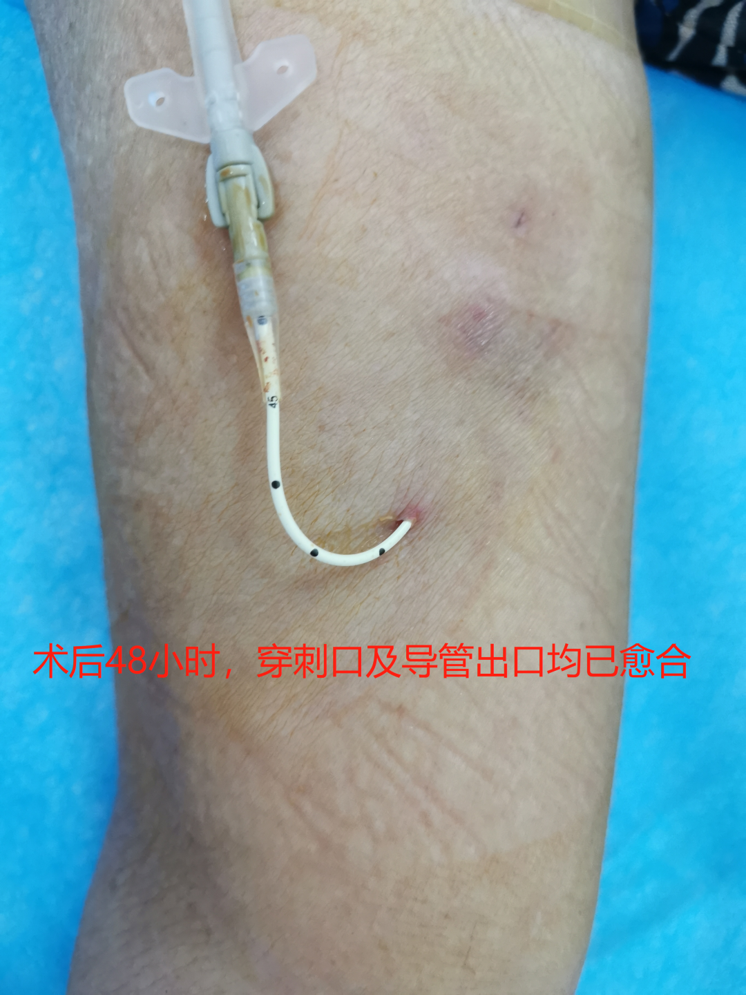 心电图怎么6道护理 ｜ 我院成功开展粤东首例腔内心电图定位下隧道式PICC置管术，化疗患者“生命绿色通道”更耐用_https://www.jmylbn.com_新闻资讯_第8张