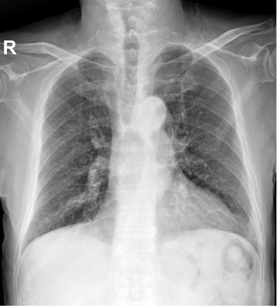 X光拍片为什么要等床边拍片“想拍就拍”？非必要，不要以床边拍片代替放射科拍片_https://www.jmylbn.com_新闻资讯_第7张