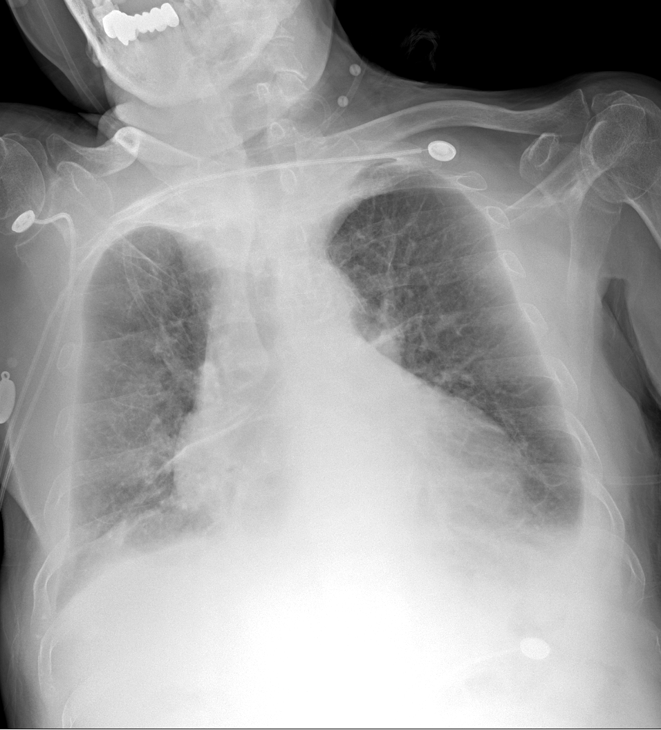 X光拍片为什么要等床边拍片“想拍就拍”？非必要，不要以床边拍片代替放射科拍片_https://www.jmylbn.com_新闻资讯_第6张