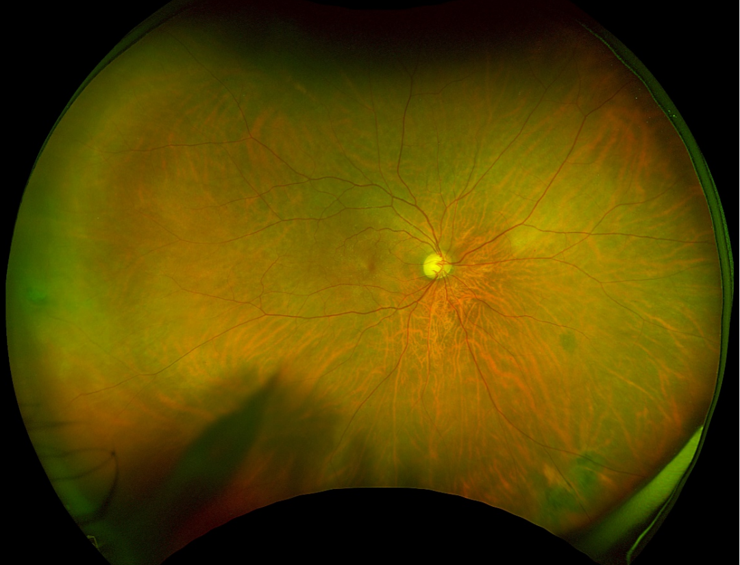 检眼镜怎么看眼底检查新“”神器“”——超广角激光扫描检眼镜_https://www.jmylbn.com_新闻资讯_第11张