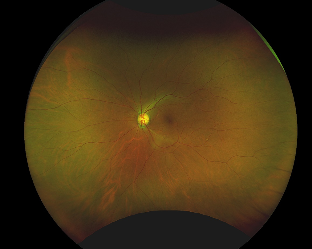 检眼镜怎么看眼底检查新“”神器“”——超广角激光扫描检眼镜_https://www.jmylbn.com_新闻资讯_第6张