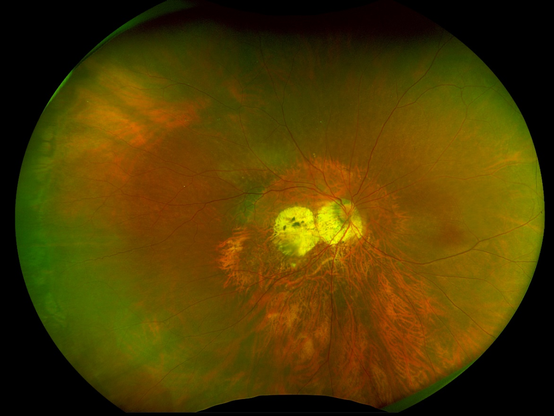 检眼镜怎么看眼底检查新“”神器“”——超广角激光扫描检眼镜_https://www.jmylbn.com_新闻资讯_第7张