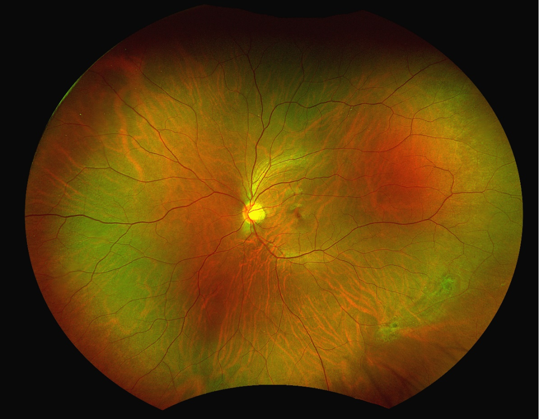 检眼镜怎么看眼底检查新“”神器“”——超广角激光扫描检眼镜_https://www.jmylbn.com_新闻资讯_第9张