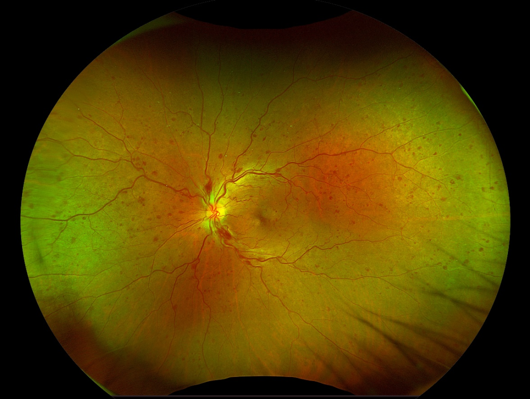 检眼镜怎么看眼底检查新“”神器“”——超广角激光扫描检眼镜_https://www.jmylbn.com_新闻资讯_第8张