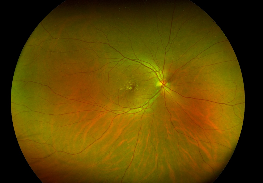 检眼镜怎么看眼底检查新“”神器“”——超广角激光扫描检眼镜_https://www.jmylbn.com_新闻资讯_第12张