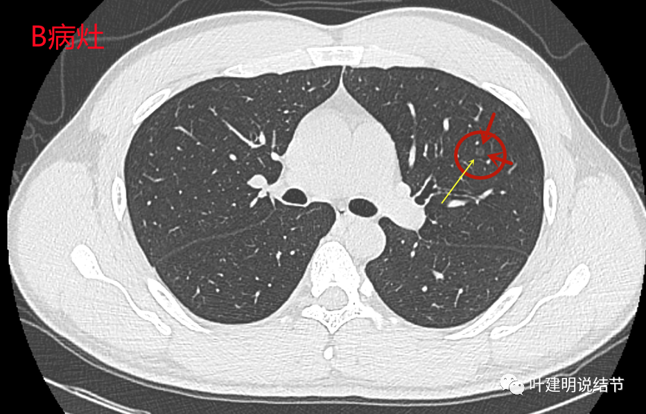 位置左上葉舌段,伴有中間小空泡的微小磨玻璃結節,密度甚低,同樣瘤肺