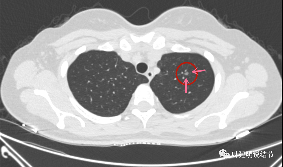 问诊仅30岁的女子两肺多达11处磨玻璃结节该干预