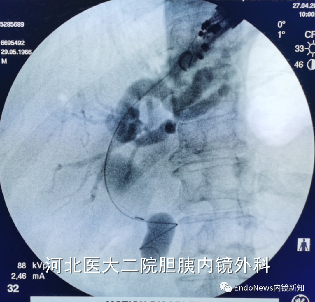 取石网篮 为什么贵EUS-BD操作中的细节：导丝如何超选？_https://www.jmylbn.com_新闻资讯_第40张