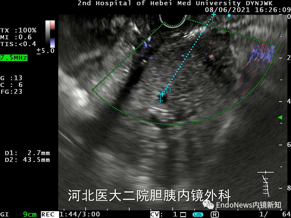 取石网篮 为什么贵EUS-BD操作中的细节：导丝如何超选？_https://www.jmylbn.com_新闻资讯_第7张