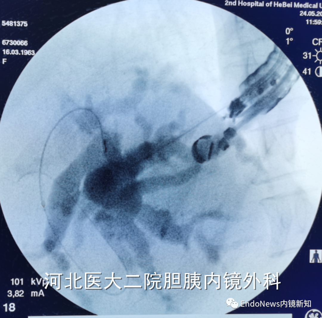 取石网篮 为什么贵EUS-BD操作中的细节：导丝如何超选？_https://www.jmylbn.com_新闻资讯_第29张