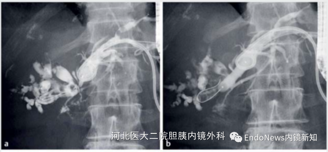 取石网篮 为什么贵EUS-BD操作中的细节：导丝如何超选？_https://www.jmylbn.com_新闻资讯_第16张