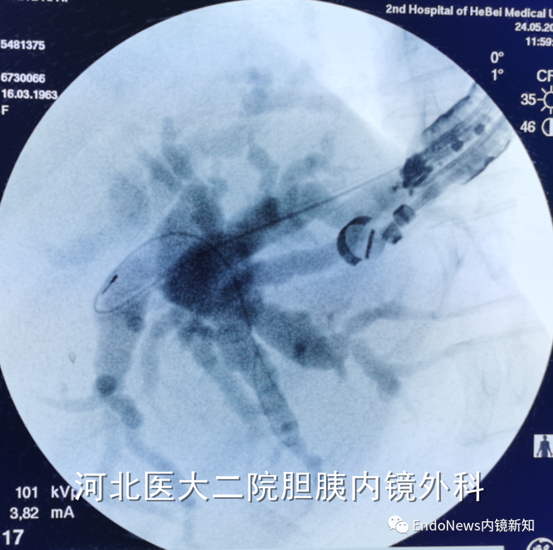 取石网篮 为什么贵EUS-BD操作中的细节：导丝如何超选？_https://www.jmylbn.com_新闻资讯_第28张