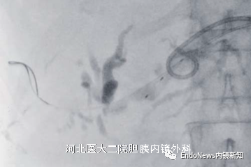 取石网篮 为什么贵EUS-BD操作中的细节：导丝如何超选？_https://www.jmylbn.com_新闻资讯_第19张