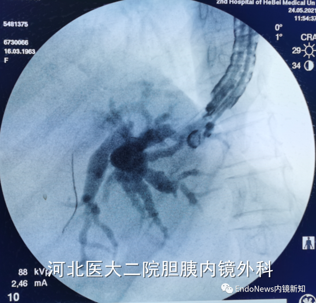 取石网篮 为什么贵EUS-BD操作中的细节：导丝如何超选？_https://www.jmylbn.com_新闻资讯_第21张