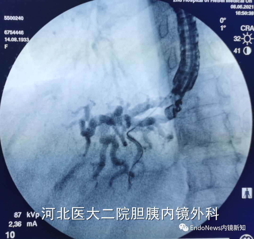 取石网篮 为什么贵EUS-BD操作中的细节：导丝如何超选？_https://www.jmylbn.com_新闻资讯_第10张