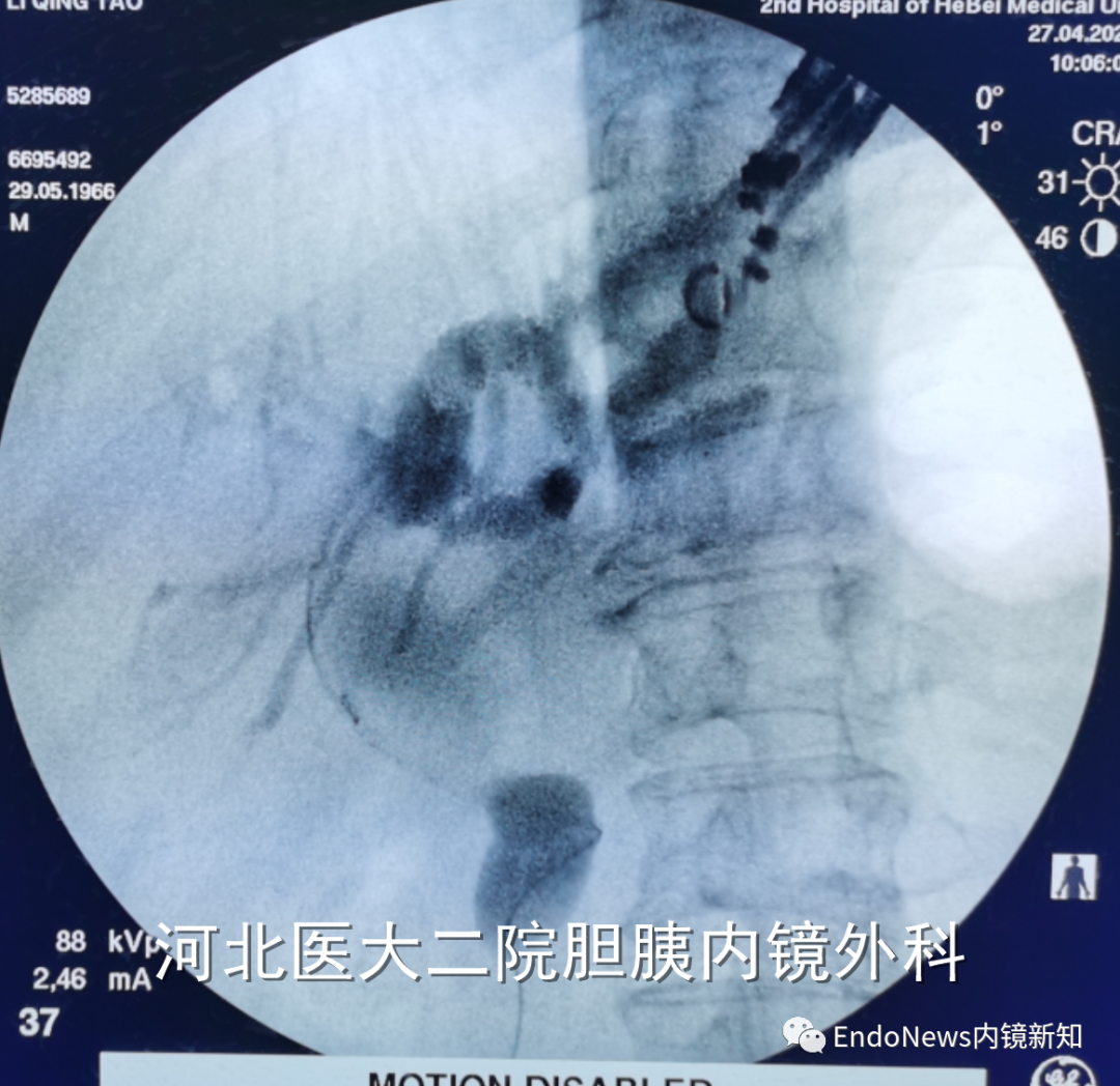 取石网篮 为什么贵EUS-BD操作中的细节：导丝如何超选？_https://www.jmylbn.com_新闻资讯_第44张