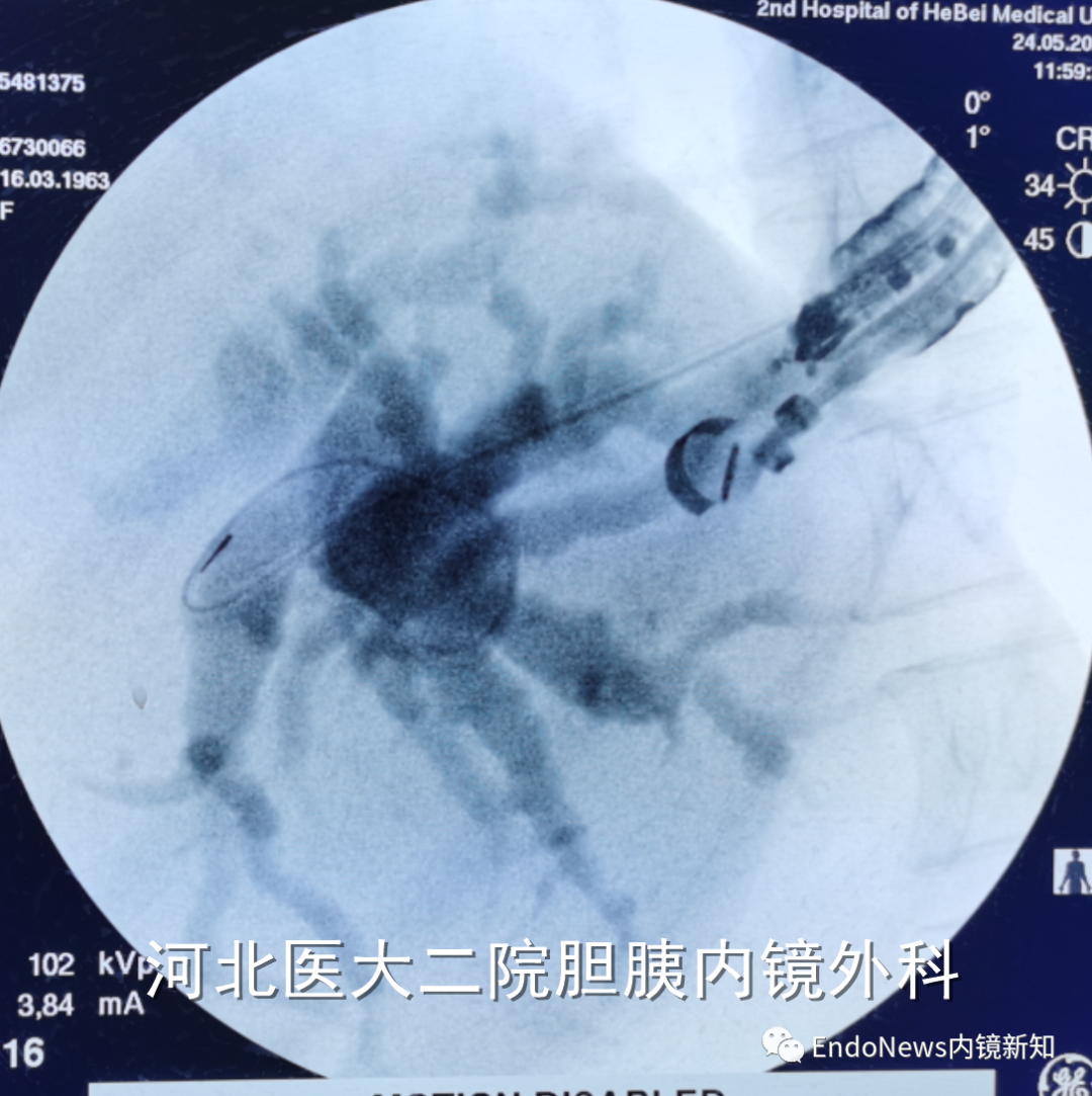 取石网篮 为什么贵EUS-BD操作中的细节：导丝如何超选？_https://www.jmylbn.com_新闻资讯_第27张