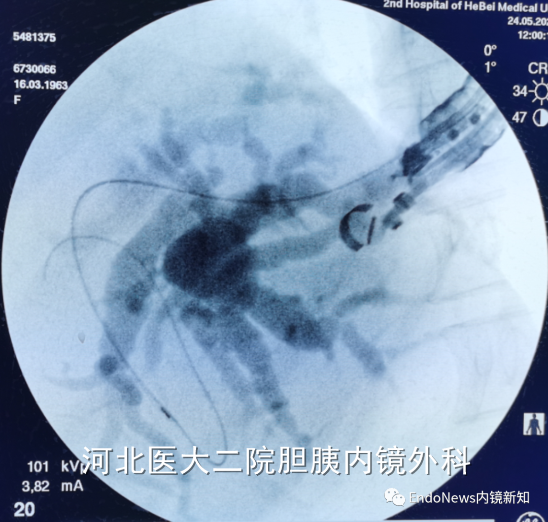 取石网篮 为什么贵EUS-BD操作中的细节：导丝如何超选？_https://www.jmylbn.com_新闻资讯_第31张