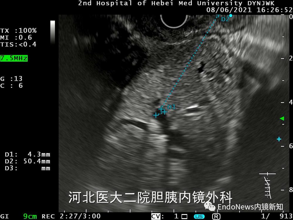 取石网篮 为什么贵EUS-BD操作中的细节：导丝如何超选？_https://www.jmylbn.com_新闻资讯_第8张