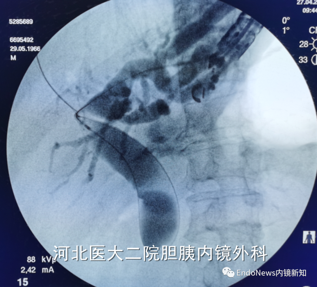 取石网篮 为什么贵EUS-BD操作中的细节：导丝如何超选？_https://www.jmylbn.com_新闻资讯_第32张