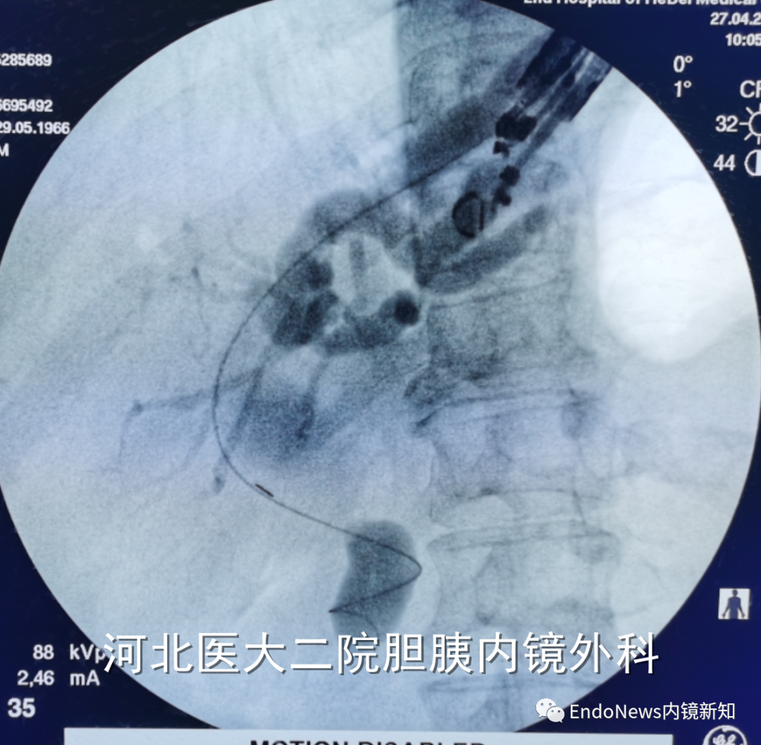 取石网篮 为什么贵EUS-BD操作中的细节：导丝如何超选？_https://www.jmylbn.com_新闻资讯_第42张
