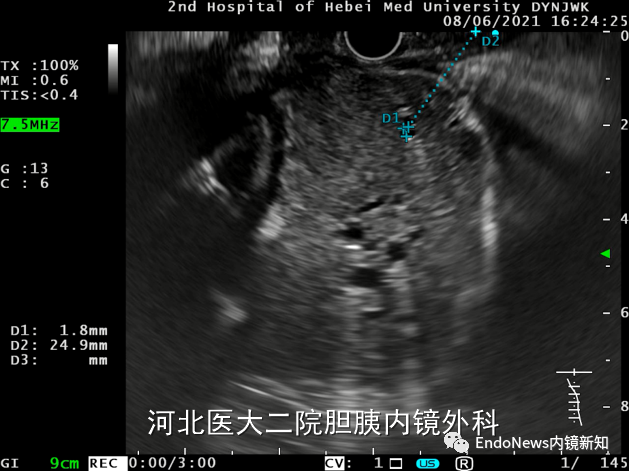 取石网篮 为什么贵EUS-BD操作中的细节：导丝如何超选？_https://www.jmylbn.com_新闻资讯_第6张