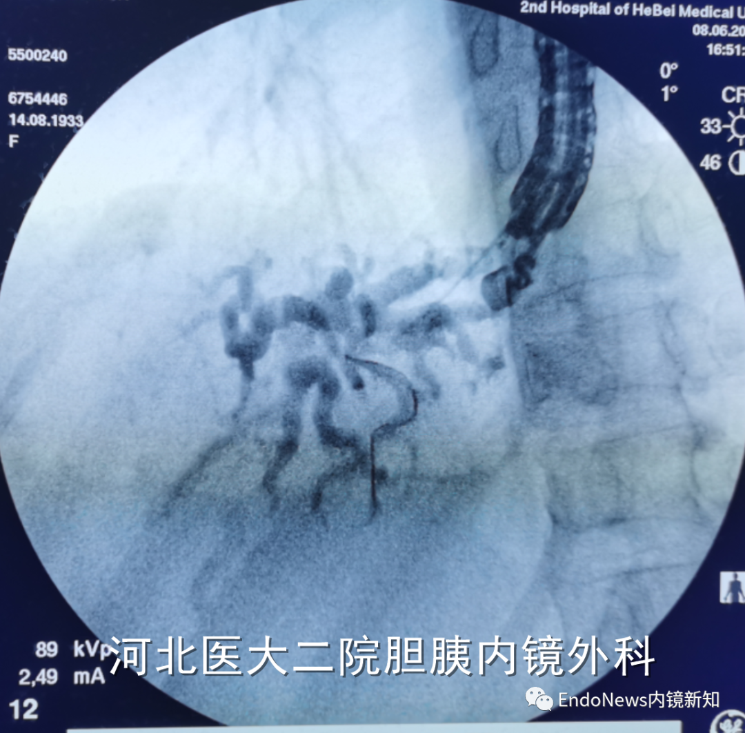 取石网篮 为什么贵EUS-BD操作中的细节：导丝如何超选？_https://www.jmylbn.com_新闻资讯_第12张