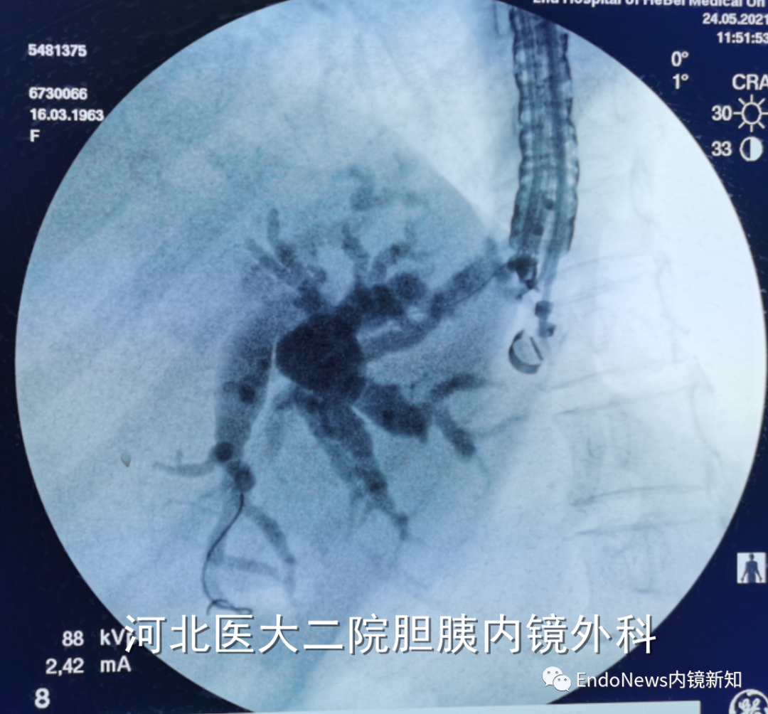 取石网篮 为什么贵EUS-BD操作中的细节：导丝如何超选？_https://www.jmylbn.com_新闻资讯_第20张