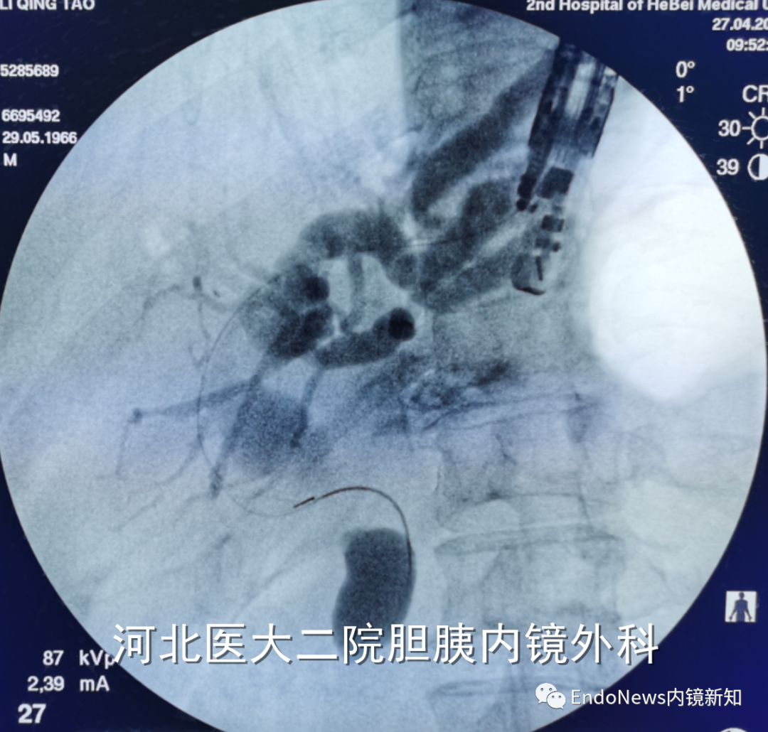 取石网篮 为什么贵EUS-BD操作中的细节：导丝如何超选？_https://www.jmylbn.com_新闻资讯_第36张