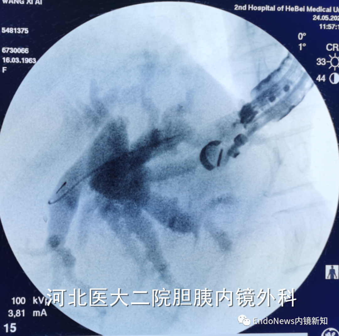取石网篮 为什么贵EUS-BD操作中的细节：导丝如何超选？_https://www.jmylbn.com_新闻资讯_第26张
