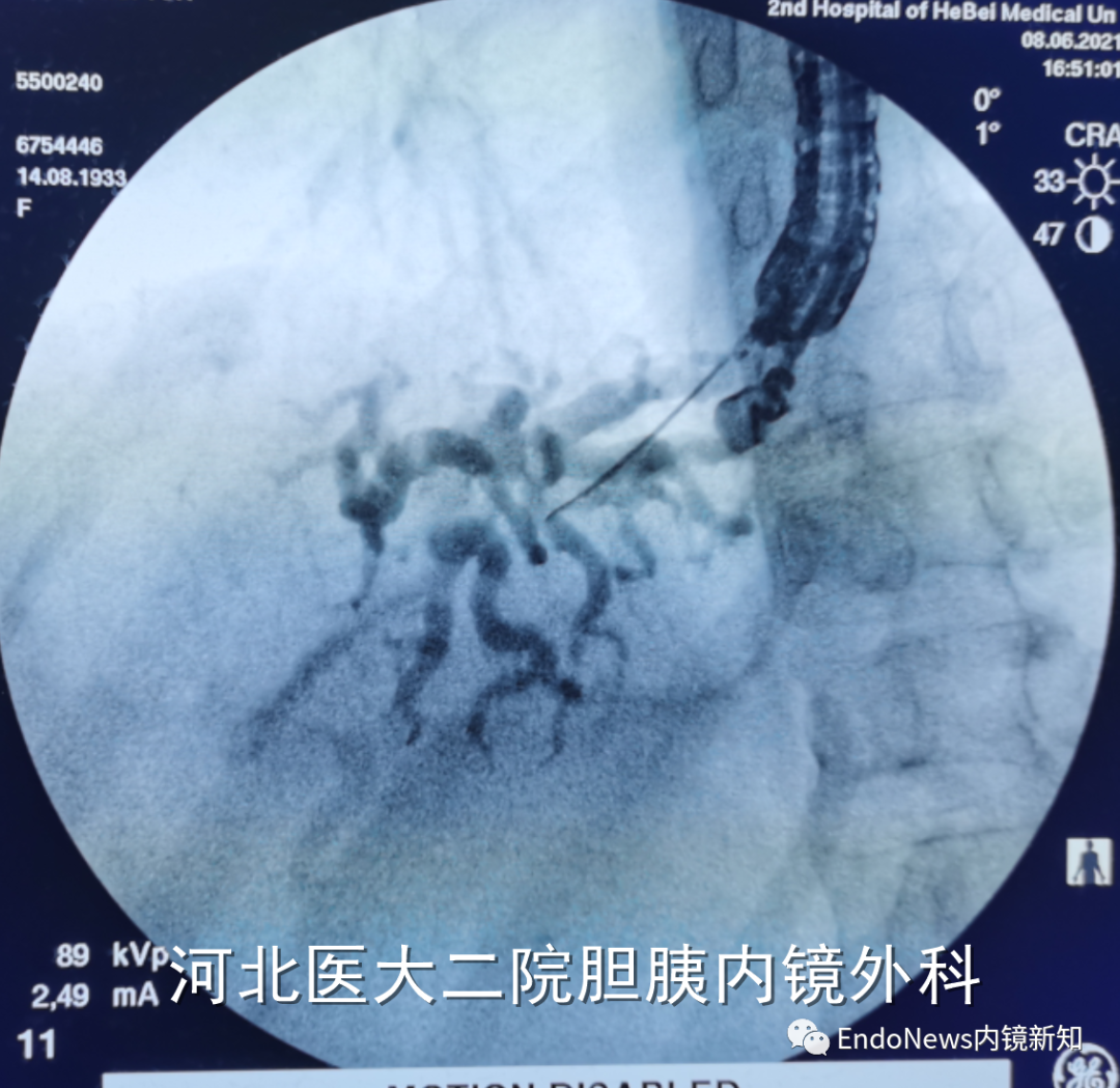 取石网篮 为什么贵EUS-BD操作中的细节：导丝如何超选？_https://www.jmylbn.com_新闻资讯_第11张