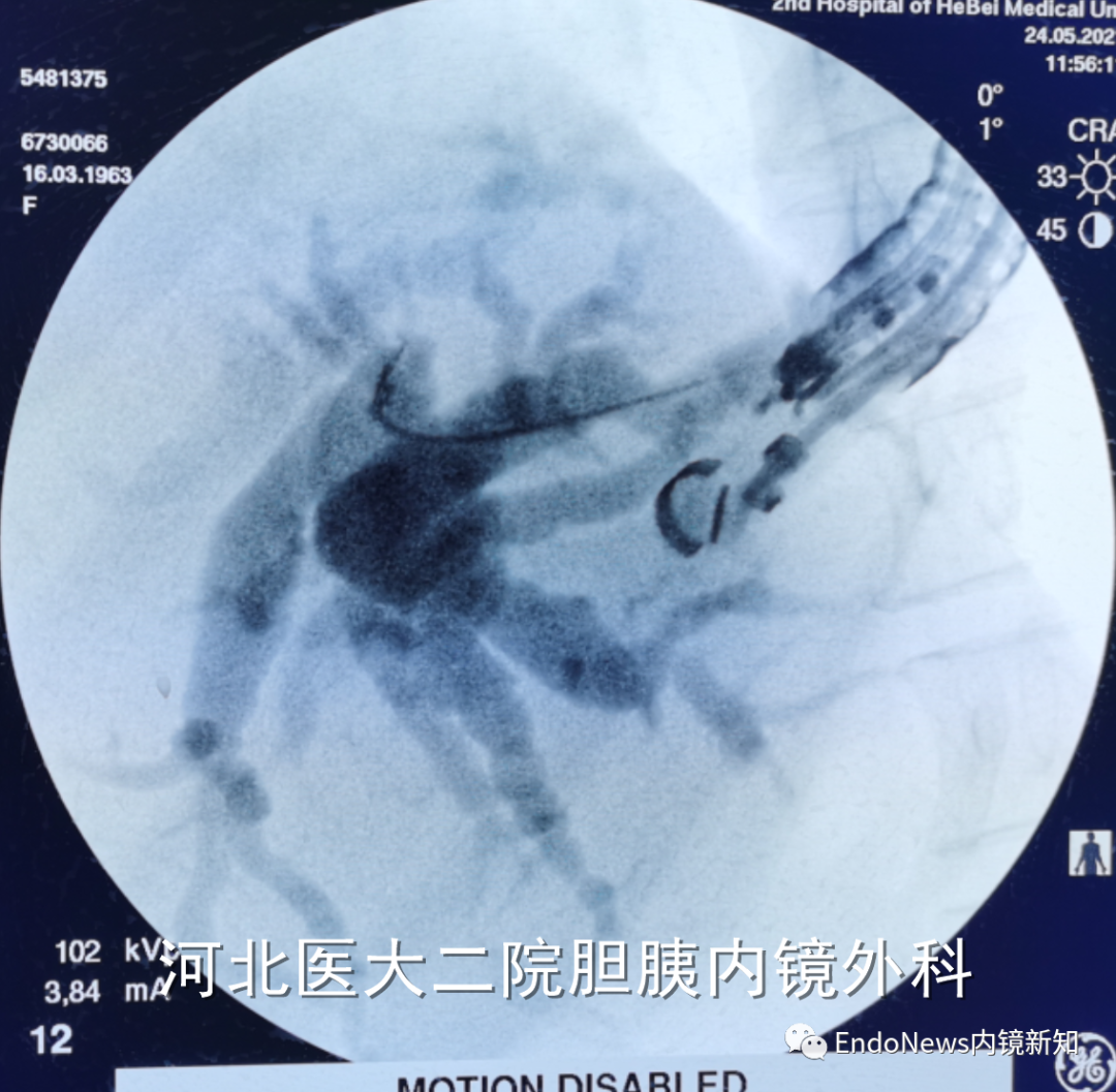 取石网篮 为什么贵EUS-BD操作中的细节：导丝如何超选？_https://www.jmylbn.com_新闻资讯_第23张