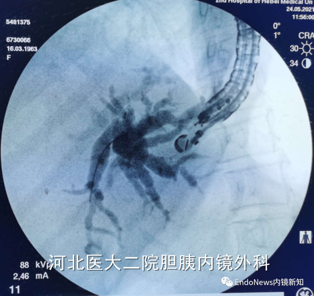 取石网篮 为什么贵EUS-BD操作中的细节：导丝如何超选？_https://www.jmylbn.com_新闻资讯_第22张